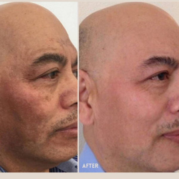 LasmaX-Skin® Skin Lightening Cream